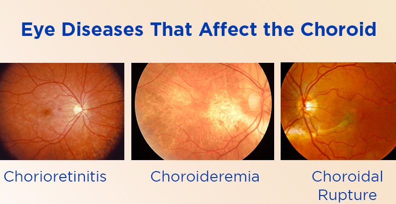 choroiditis and homoeopathy treatment