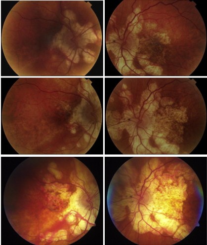 Choroiditis and homoeopathy treatment